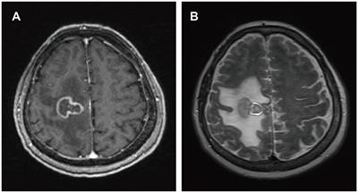 A disease warranting attention from neurosurgeons: primary central nervous system post-transplant lymphoproliferative disorder